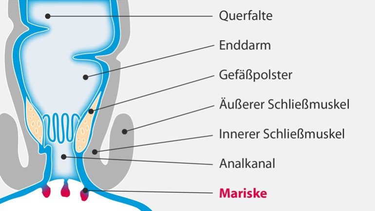 Marisken: Harmlose Analerkrankung