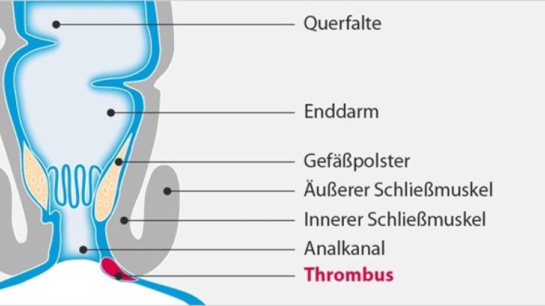 Analthrombose: Schmerzhafte Knubbel am After