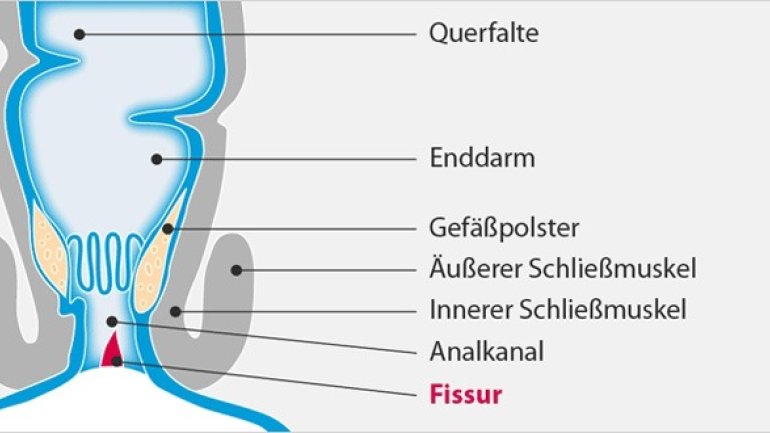 Analfissur: Häufige Analerkrankung