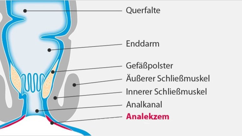 After juckt und brennt: Möglicherweise ein Analekzem