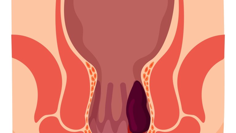 Hämorrhoiden: Häufige Analerkrankung