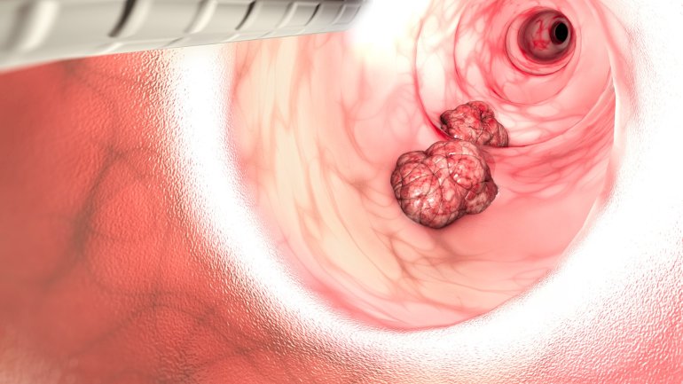 Schwere Analerkrankung: Darmkrebs