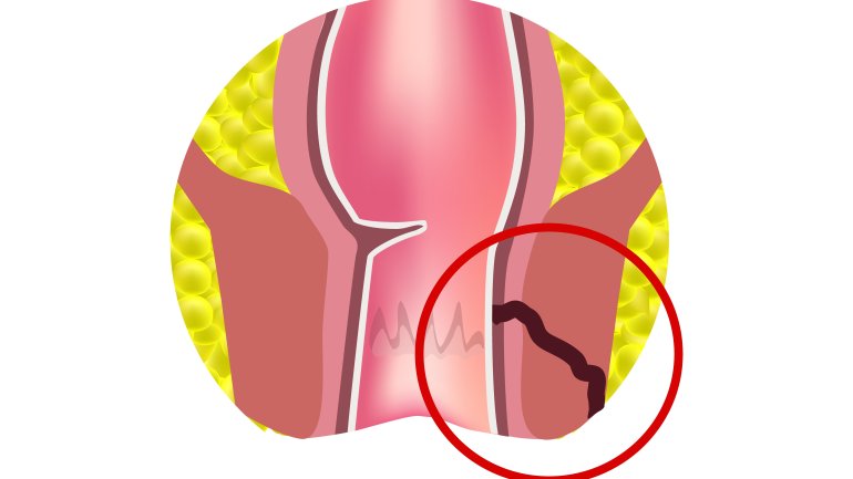 Analfistel entsteht aus Analabszess