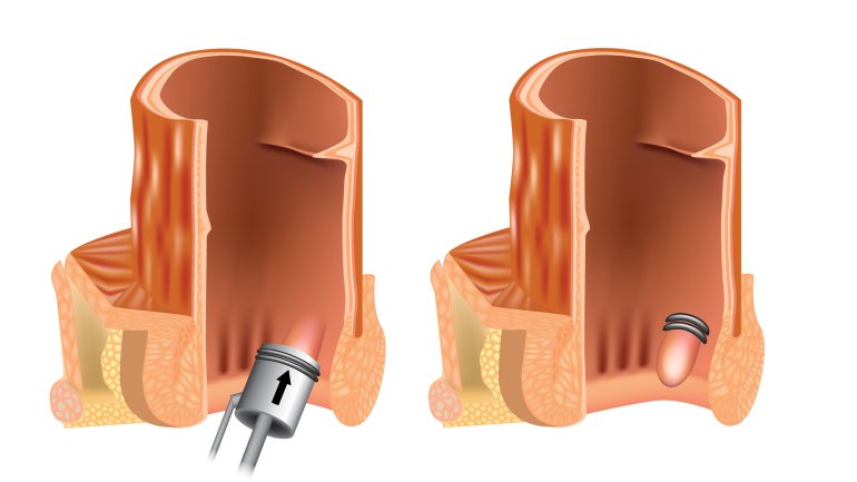 Gummibandligatur von Hämorrhoiden